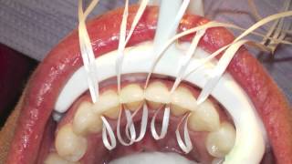 Retanium Splint Placement Orthodontics [upl. by Joh739]