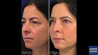 Daily Healing Progress Fat Transfer Upper amp Lower Blepharoplasty Photos [upl. by Gellman]