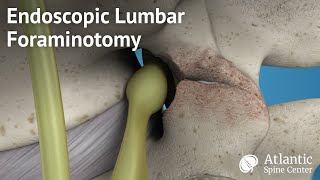 Endoscopic Lumbar Foraminotomy [upl. by Dorrahs]