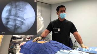 Radiofrequency Ablation Procedure [upl. by Trevlac]