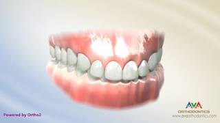 Orthodontic Treatment for Deepbite  Wire with Reverse Curve of Spee [upl. by Tsirhc]