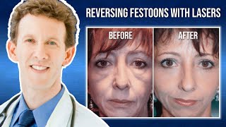 Laser Skin Resurfacing for Festoons with Dr Adam Scheiner [upl. by Assen]