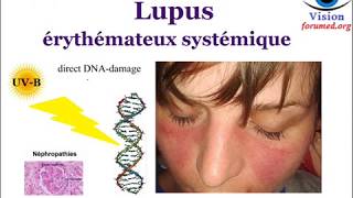 Lupus érythémateux Systémique Signes cliniques Biologiques physiopathologie [upl. by Acsehcnarf]