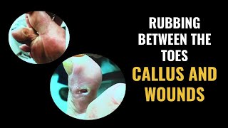 Rubbing Between The Toes  Calluses and Wounds [upl. by Aurora]