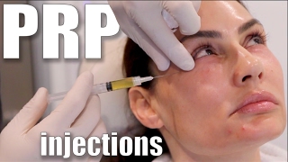 PRP Injections to Face and Neck Blood Facial [upl. by Neros338]