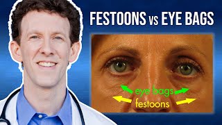 What Are Eye Festoons vs Lower Eyelid Bags [upl. by Yeorgi]