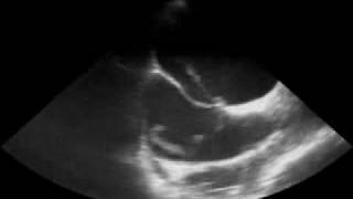 Thrombus in a Patent Foramen Ovale [upl. by Casady]