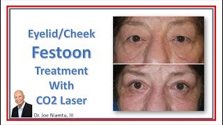 Festoon Treatment with CO2 Laser [upl. by Octavus454]