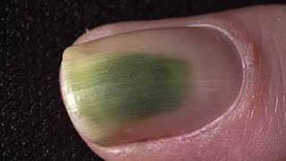 Green Toenail Fungus Cure Home Treatment Guide [upl. by Liagiba]