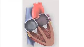 Patent Foramen Ovale PFO and Migraine [upl. by Tempest]