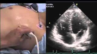 Intro to Echo Apical 4 Chamber Viewmov [upl. by Asenad]