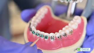 Remove the Entire Archwire  Freeman Orthodontics Sarasota FL [upl. by Vinnie612]