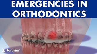 How to FIX BROKEN BRACES and other orthodontic emergencies poking wire loose bands © [upl. by Ingra]