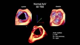 3D Echocardiography Acquisition Cropping and Case Examples [upl. by Henke]