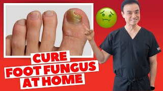 6 Effective HOME REMEDIES To CURE Toenail FUNGUS  Holistic Toenail Fungus Cures Part 2  Dr Kim [upl. by Read]