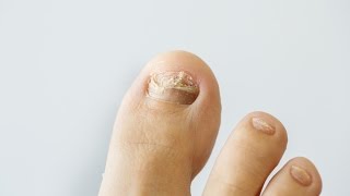 How to prevent and treat nail fungus [upl. by Leoline161]