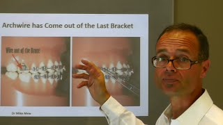 What to do at Home If Archwire has Come out of the Last Orthodontic Bracket by Dr Mike Mew [upl. by Anatol380]