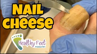 CUTTING NAILS with TOE CHEESE [upl. by Heidie650]