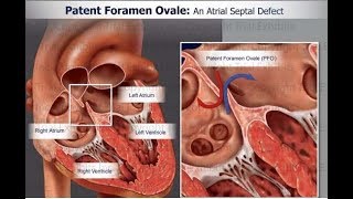 Patent foramen ovale PFO Part II [upl. by Ahsinot586]