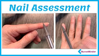 Nail Assessment for Nursing Normal and Abnormal Findings [upl. by Suilmann]