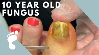 Fungus Takes Over Toenail  Toenail Removal [upl. by Larsen268]