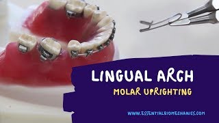 LingualArchforMolarUprighting [upl. by Catriona]