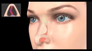 Deviated Septum Surgery Septoplasty [upl. by Nnaear]