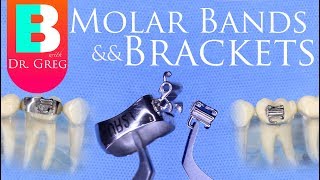 Braces Bands vs Brackets for Molars in Orthodontics [upl. by Otreblif219]