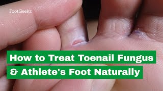 How to Treat Toenail Fungus amp Athletes Foot Naturally [upl. by Ruperta]