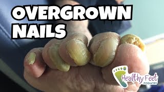 Overgrown Toe Nails [upl. by Enyamrahs]