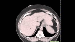 CT Epiploic Appendagitis [upl. by Jaynes]